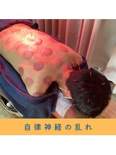 いつつのき/カッピング×鍼