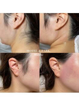 ホテルアンドパーク(HOTEL&PARK.)/うなじ&もみあげワックス脱毛