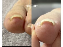 エイミー(eimii)/巻き爪ケア