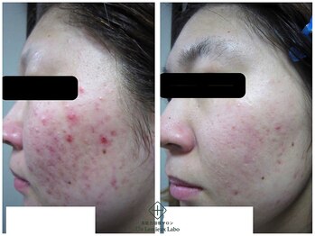 アンレミューラボ(Un Lemieux Labo)/赤みのあるニキビ改善