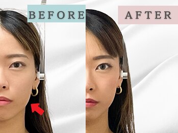 エルシンメトリー矯正院(ailesシンメトリー矯正院)/before＆after　ailes式小顔矯正