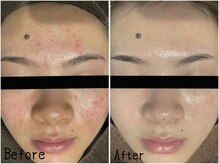 レイズ(RAISE)/当店人気No.1 水光ピーリング