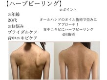 サロンツキ(salon tuki)/ハーブピーリング症例/徳島