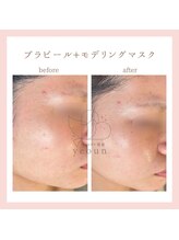 韓国肌管理yeoun【ヨウン】ROMAPINK/黒ずみ/毛穴/プラピール/ララピール福岡天神/プラピール/プラピール福岡