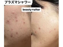 マニス(manis)/プラズマシャワー