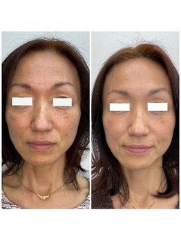 モモン シャルール/ヒト幹細胞コスメでハリ・艶up