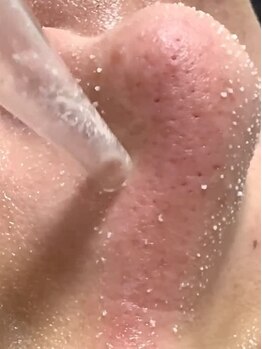 毛穴ケアをしたい