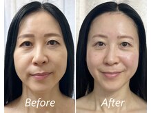 ドクターボディ 新宿店(Dr.Body)/【たるみ/左右差/面長 50代】