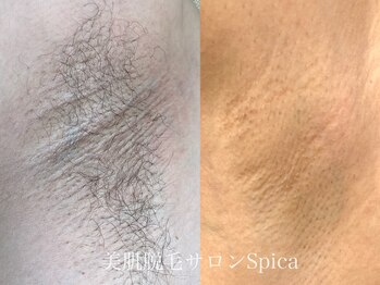 スピカ(SPICA)/脇脱毛