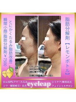 アイリープ(eyeleap)/☆レモンボトルビフォーアフター