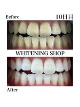 ホワイトニングショップ 刈谷店/Before&After 10日目のお客様