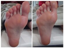 アンティ(Aunty)/関節や足裏のタコ（胼胝）