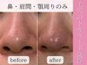 【小鼻の黒ずみ・角栓ケア】Tゾーン集中トルネード洗浄！至近距離もOK