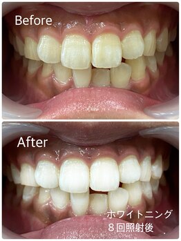 クリア(Clear)の写真/【姫路駅から5分】綺麗は歯から！話題のセルフホワイトニングで自分磨きしてみませんか☆