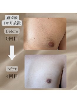 ネイチャー(Nature)/【胸脱毛BeforeAfter】