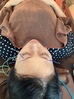 ハリファ鍼灸院 横浜関内院(HariFa鍼灸院)/美容施術