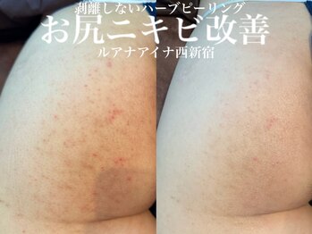 ルアナアイナ(Luana Aina)/お尻ケア/ハーブピーリング