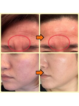 ジョルジオ東京/プラズマフラクショナル