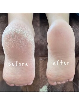 エヴィス(Evisu)/《ボディ》フット角質ケア