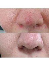 ウイユ(Oeil)/根深い毛穴の悩みにもお勧めです