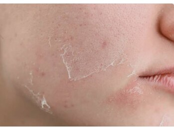 グレース(grace)/剥離後はつる肌卵肌へ◎