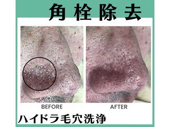 ピアリーノ(Pialino)/ハイドラ毛穴洗浄