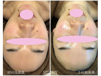 ストーリー(STORY)/ハーブピーリング専門店STORY