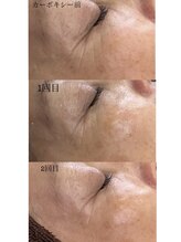 ビレイナ(BIREINA)/＊カーボキシー炭酸パック＊