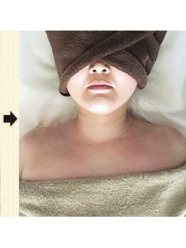 ノットノット 自由が丘(Not Knot)/オプション：首肩デコルテ 1回後
