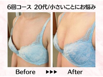 美人バスト リグラス(ReGrous)/バストアップbefore,after