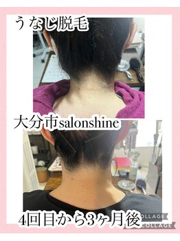 サロンシャイン(Salon Shine)/見た目が変わるうなじ脱毛