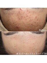 サロンヴェアリー 広尾(salon vary)/水玉＆白玉肌管理