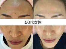 シミケア専門店 SAKURA 平塚店/平塚シミケア/伊勢店シミケア