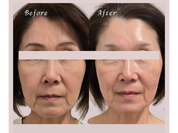 クリニカルスイート エーアール(Clinical sweet.ar)/たるみ改善、顔全体が引き上がる