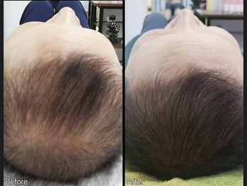 キュライム 熊本(CURAIM)/育毛促進【40代男性】