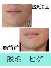 エミナル(EMINAL)/～ヒゲ脱毛の効果～脱毛/髭脱毛