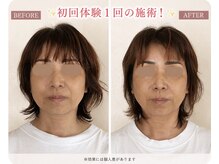 リフェイス(RE:FACE)