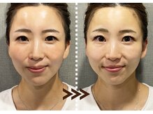 リエイト(Re:eight)/ハーブピーリング