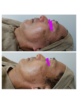 奏美/ピーリング