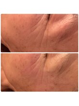 ジョルジオ東京/プラズマフラクショナル