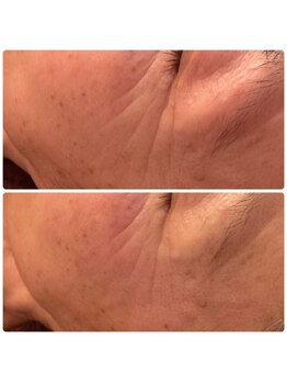 ジョルジオ東京/プラズマフラクショナル