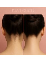 ラヴィソン(ravissant)/脱毛サロン ラヴィソンです♪