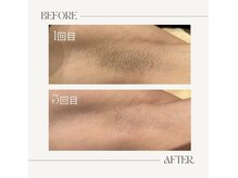 カッツ 宮通り(CUTS)/CUT'Sハイブリット脱毛