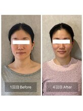 サロン グリッター 新宿(Salon GLITTER)/【小顔】ビフォーアフター