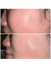 ミニョン(mignon)/1回の施術で、、、