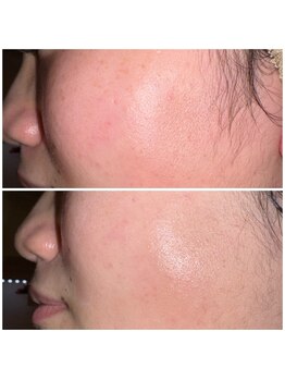 ミニョン(mignon)/1回の施術で、、、