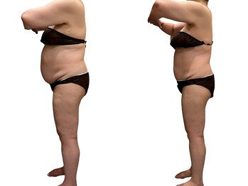 アイル(Isle)/食事制限、運動なし