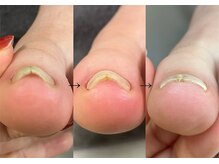 ロンディネ(Rondine)/巻き爪ケア/ネイルトリム11