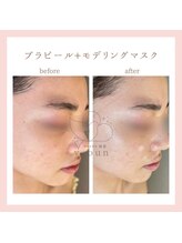 韓国肌管理yeoun【ヨウン】ROMAPINK/黒ずみ/毛穴/プラピール/ララピール福岡天神/プラピール/プラピール福岡