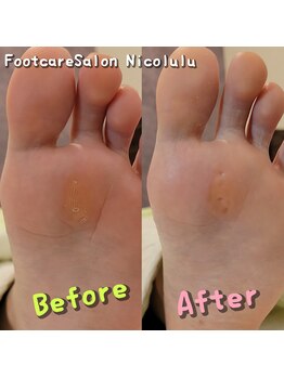ニコルル 大阪天満店(Nicolulu)/繰り返す魚の目ビフォーアフター